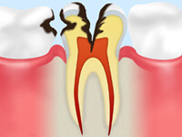 スターデンタルクリニックの虫歯治療